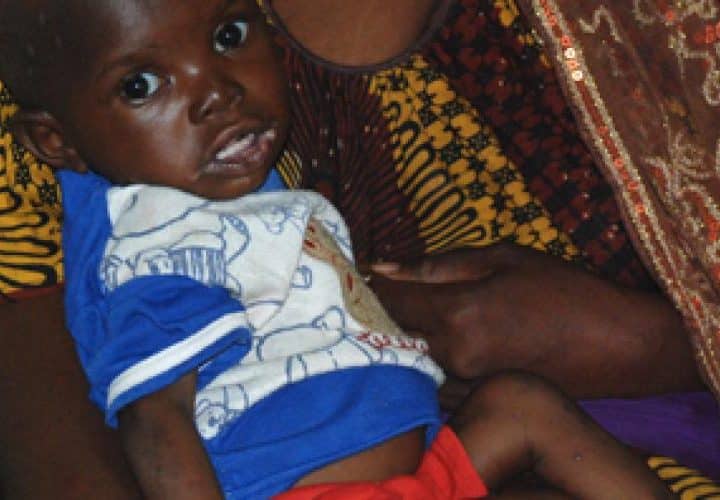 Child suffering from malnutrition in Mali